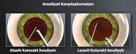 bıçaksız katarakt ameliyatı