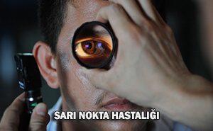 Sarı Nokta Hastalığı Nedir?
