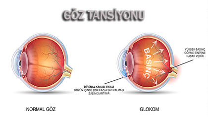 göz tansiyonu belirtileri