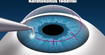 Keratokonus Teşhisi ve Tedavi Yöntemleri