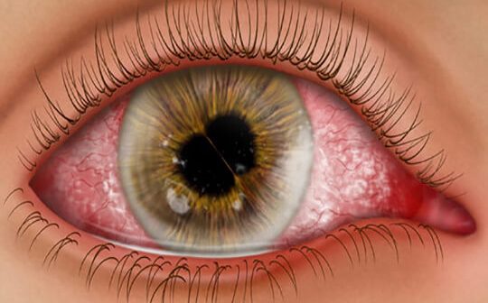 Retina dekolmanı nedir ve nasıl ortaya çıkar Retina dekolmanı nedir ve nasıl ortaya çıkar
