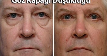 Göz Kapağı Düşüklüğü Ameliyatı göz kapağı düşüklüğü ameliyatı